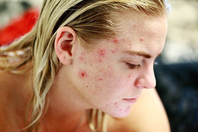 blonde girl with pimples